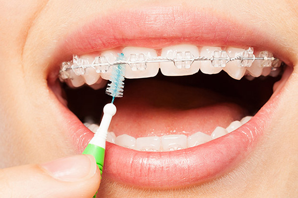 https://www.dentalcarepasadena.com/wp-content/uploads/clear-braces-2107.jpg